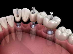 Cena implantu zęba Szczecin